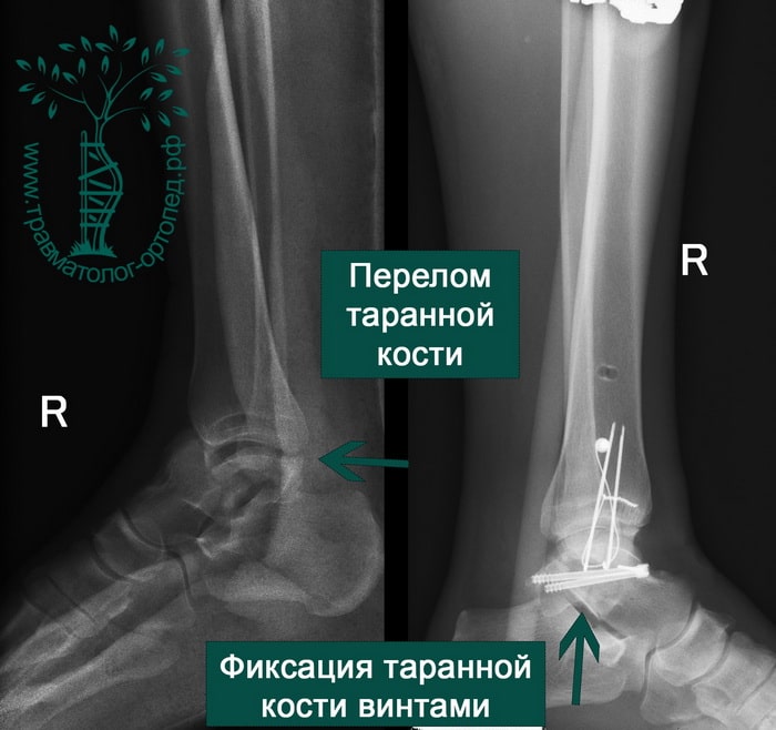 Краевой перелом таранной кости